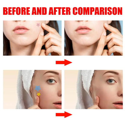 200 Patches Acnes Pimple Patches for Zits and Blemishes,Spots Treatments Stickers for Face and Skin