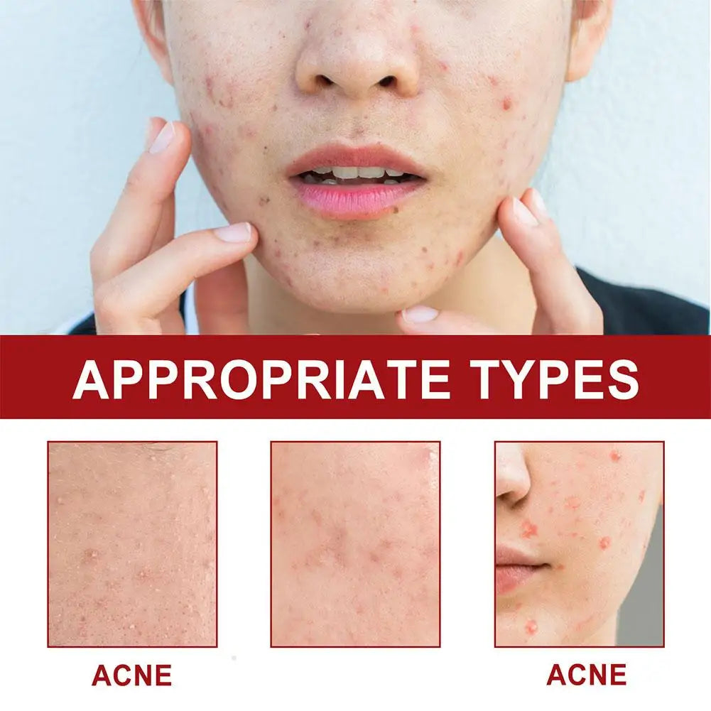 180PCS Acne Pimple Patches Colorful Breathable Acne Removal Absorb Secretions Anti Infection Originality Concealer Makeup Tool