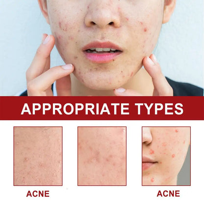 180PCS Acne Pimple Patches Colorful Breathable Acne Removal Absorb Secretions Anti Infection Originality Concealer Makeup Tool