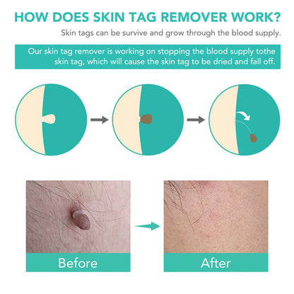 Simple Wart Removal Tool Set Skin Tag Removeal Tool Easy To Clean Skin Care Tool Skin Tag Removal Care Products