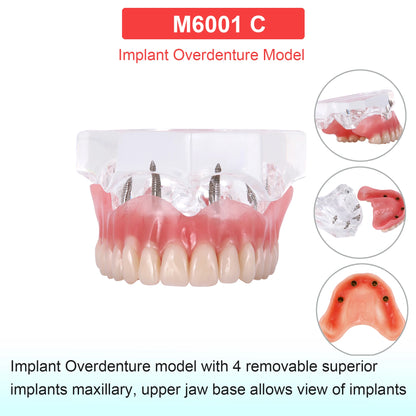 Dental Teeth Model Dental Teaching Models Implant Model Removable Dentistry Model Teeth For Training Studying Patient Education