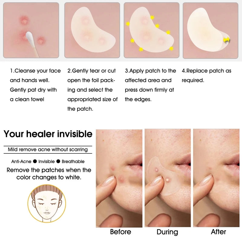 20 Patches Acne Patch Pimple Patches Blemish Protective Cover Absorbing Spot Hydrocolloid Dressing Zit Drop Shipping