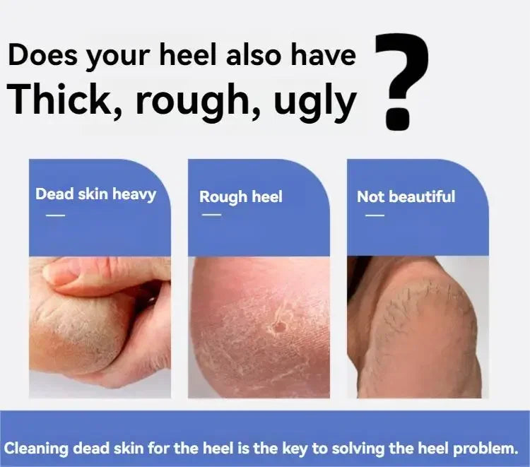 2pcs Feet Scraping Dead Skin Knife Foot Care Knife To Remove Dead Skin Knife Shaving Calluses To Remove Dead Skin Utensils