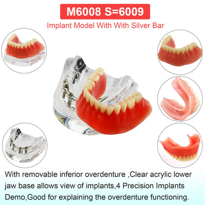 Dental Teeth Model Dental Teaching Models Implant Model Removable Dentistry Model Teeth For Training Studying Patient Education