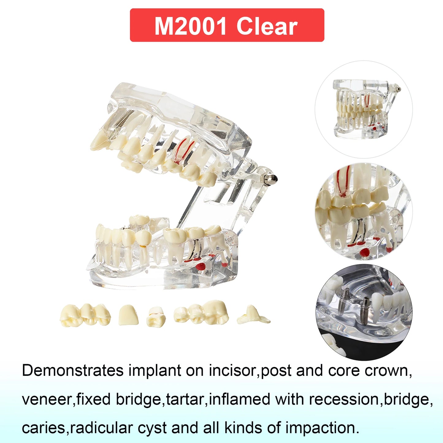 Dental Teeth Model Dental Teaching Models Implant Model Removable Dentistry Model Teeth For Training Studying Patient Education