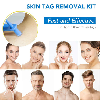 Simple Wart Removal Tool Set Skin Tag Removeal Tool Easy To Clean Skin Care Tool Skin Tag Removal Care Products