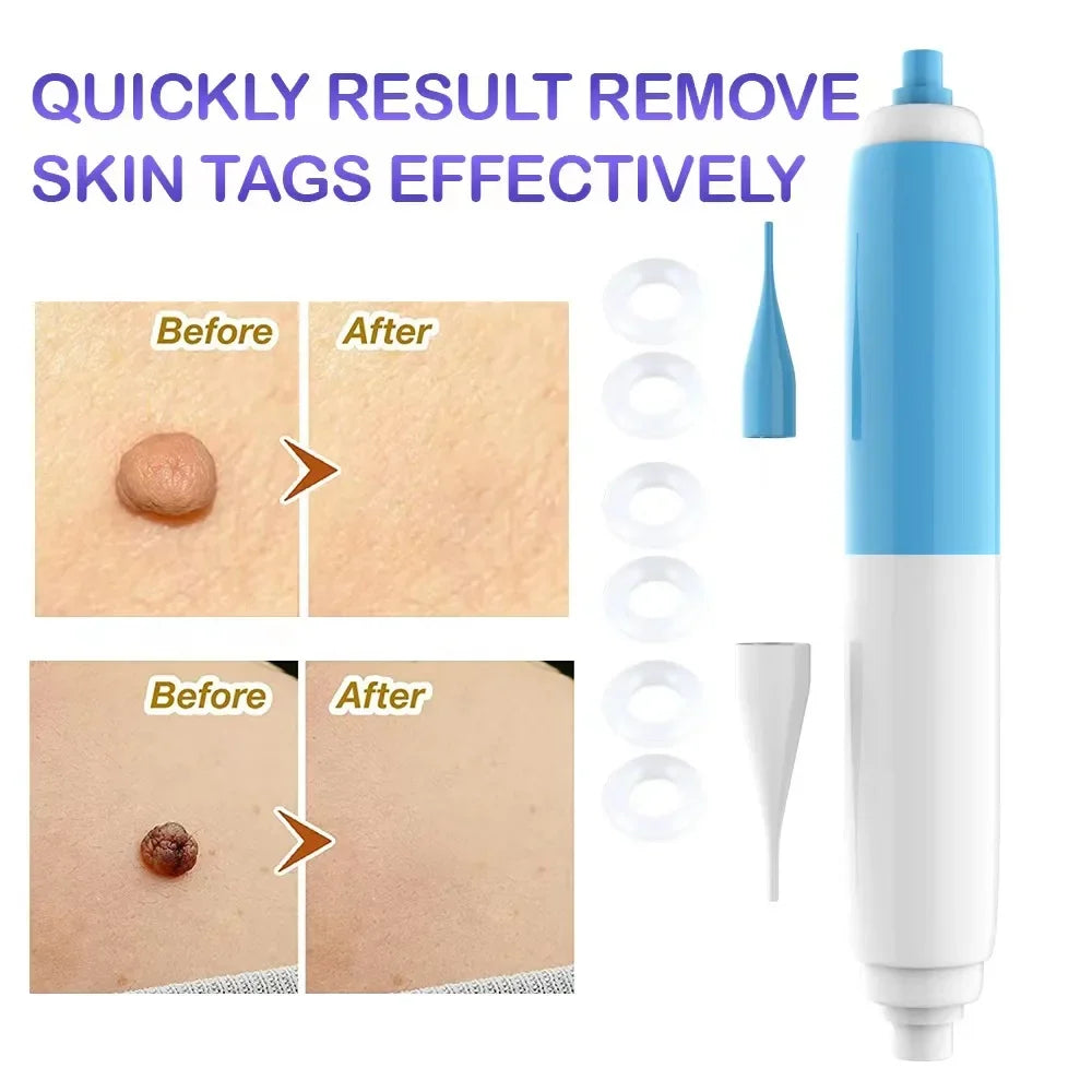 Skin Tag Removal Tool Rubber Rings Face Beauty Accessories Skin Tag Removal Device Multipurpose Supplies for Face Neck Chin Back