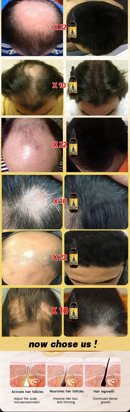2025 Hair growth oil, repair baldness, hairline, rapid hair growth hair growth oil for men