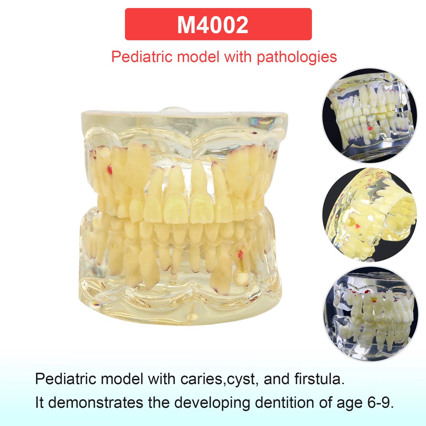 Dental Teeth Model Dental Teaching Models Implant Model Removable Dentistry Model Teeth For Training Studying Patient Education