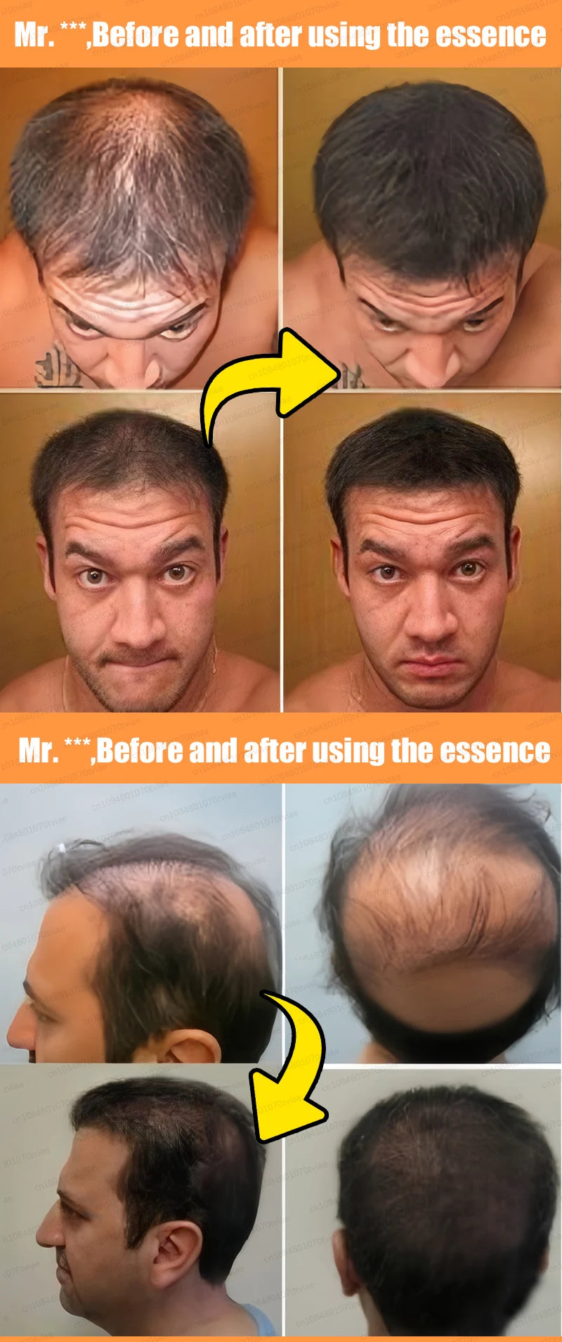 2025 Hair growth oil, repair baldness, hairline, rapid hair growth hair growth oil for men